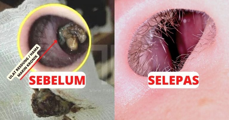 Blackened tooth decay before and after treatment showing oral health improvement.