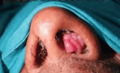 Close-up of nose with nasal polyps indicating sinus or nasal issues.