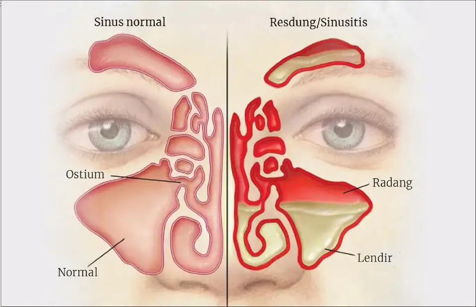 Inflamed sinus illustration showing sinusitis symptoms and anatomy for nasal health.